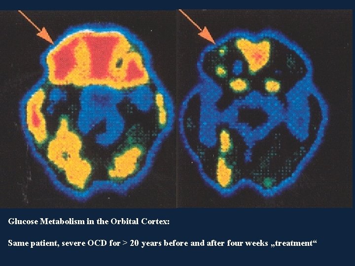 Glucose Metabolism in the Orbital Cortex: Same patient, severe OCD for > 20 years