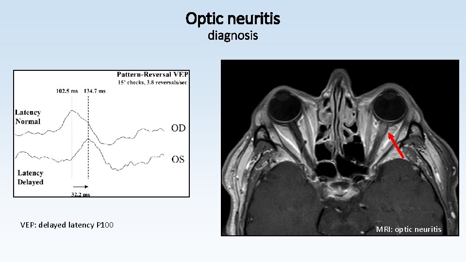 Optic neuritis diagnosis VEP: delayed latency P 100 MRI: optic neuritis 