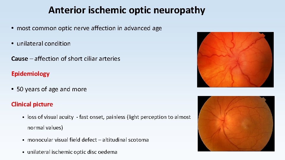 Anterior ischemic optic neuropathy • most common optic nerve affection in advanced age •