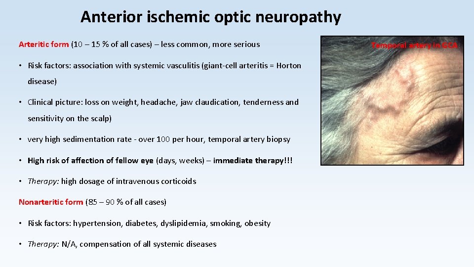 Anterior ischemic optic neuropathy Arteritic form (10 – 15 % of all cases) –