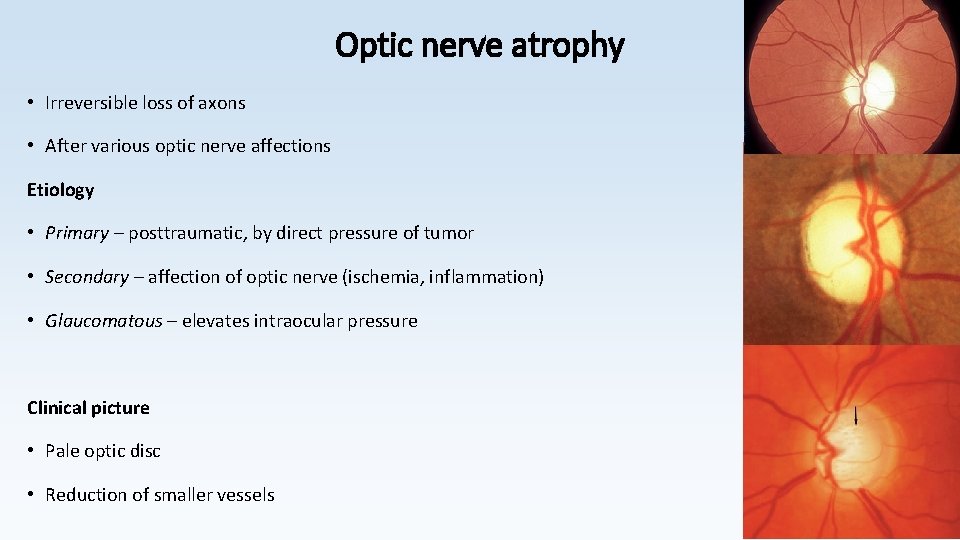 Optic nerve atrophy • Irreversible loss of axons • After various optic nerve affections