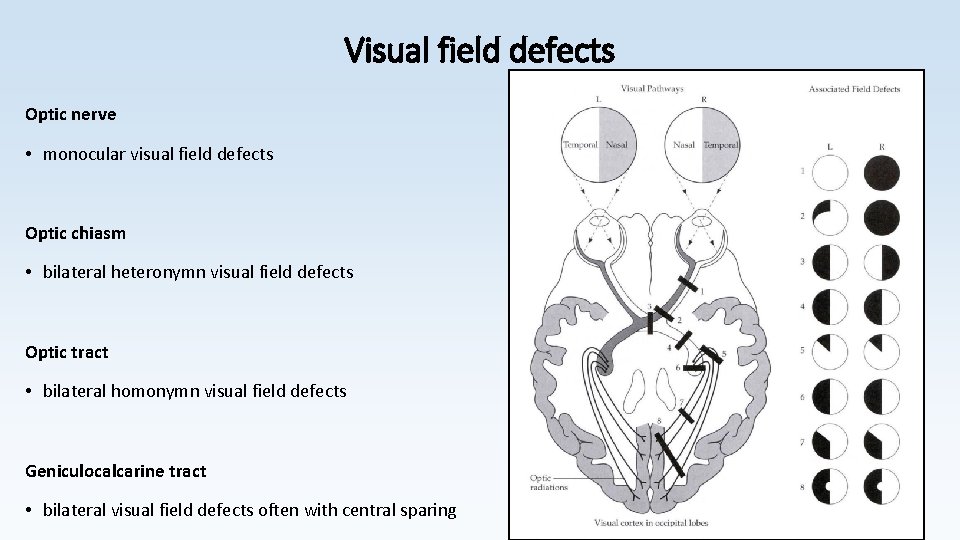 Visual field defects Optic nerve • monocular visual field defects Optic chiasm • bilateral