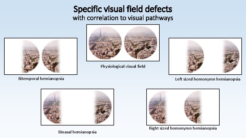 Specific visual field defects with correlation to visual pathways Physiological visual field Bitemporal hemianopsia