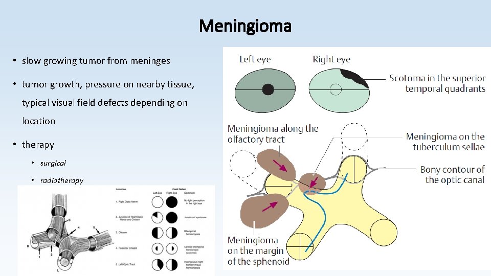 Meningioma • slow growing tumor from meninges • tumor growth, pressure on nearby tissue,