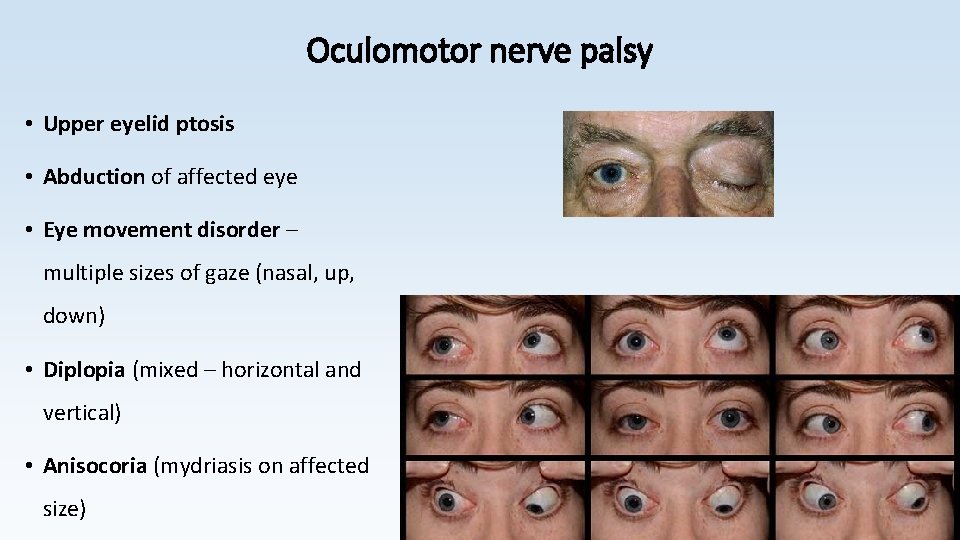 Oculomotor nerve palsy • Upper eyelid ptosis • Abduction of affected eye • Eye