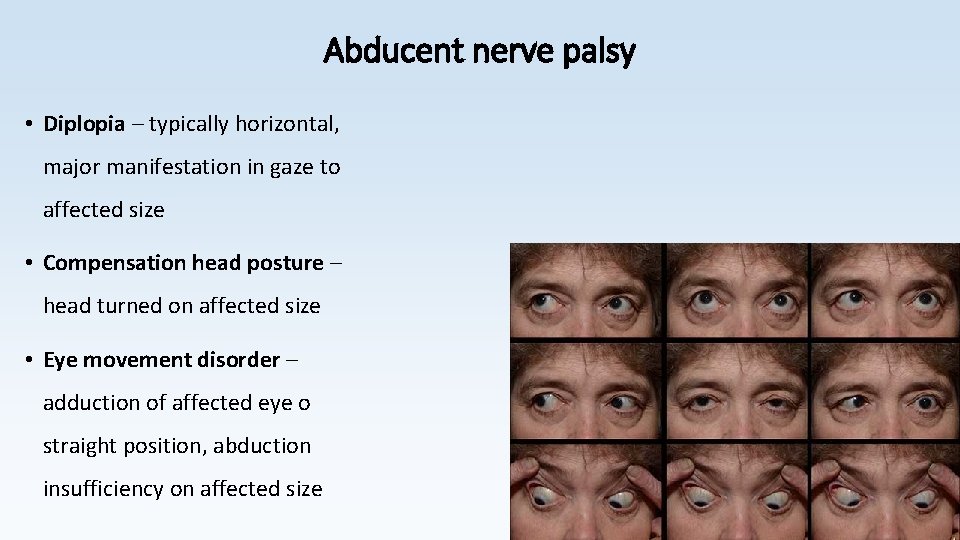 Abducent nerve palsy • Diplopia – typically horizontal, major manifestation in gaze to affected