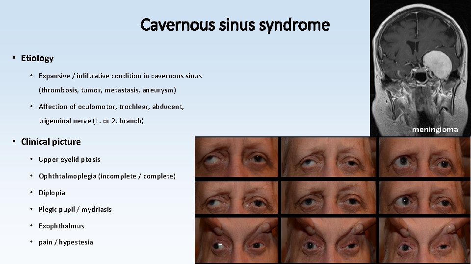 Cavernous sinus syndrome • Etiology • Expansive / infiltrative condition in cavernous sinus (thrombosis,