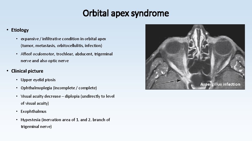 Orbital apex syndrome • Etiology • expansive / infiltrative condition in orbital apex (tumor,