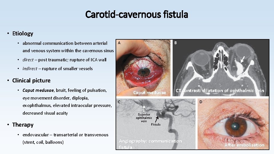 Carotid-cavernous fistula • Etiology • abnormal communication between arterial and venous system within the