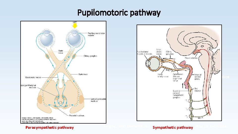 Pupilomotoric pathway Aspergillova infekce Parasympathetic pathway Angiografie: komunikace - Sympathetic fistula pathway Stav po