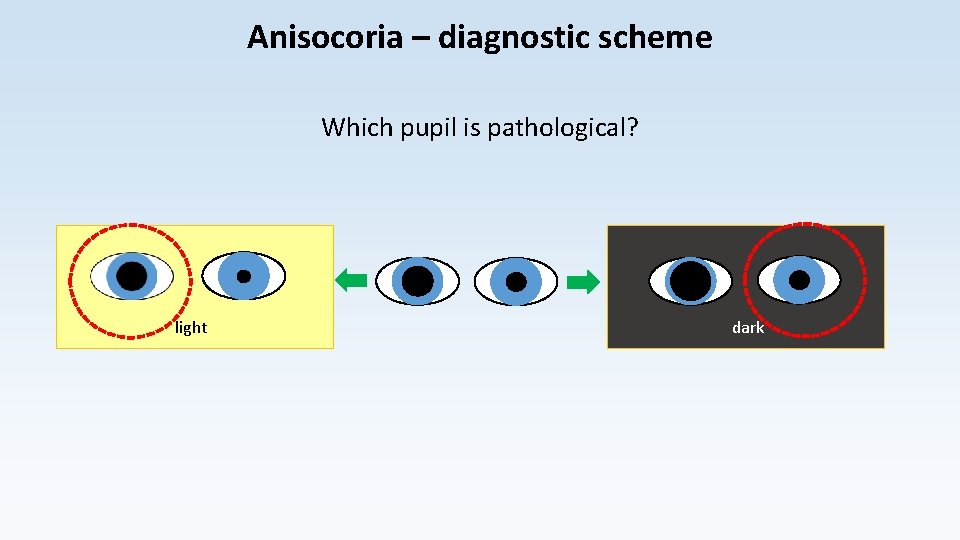 Anisocoria – diagnostic scheme Which pupil is pathological? light dark 