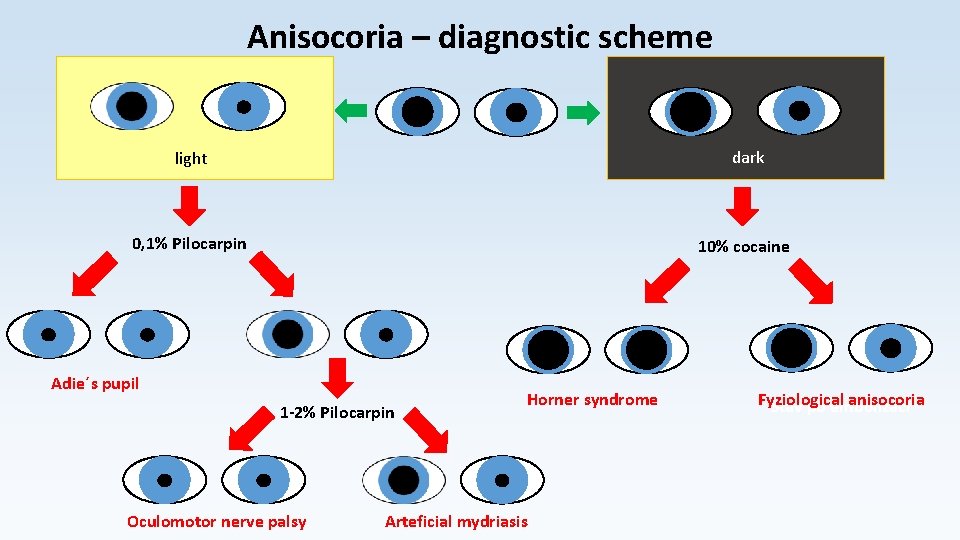 Anisocoria – diagnostic scheme light dark 0, 1% Pilocarpin 10% cocaine Adie´s pupil 1