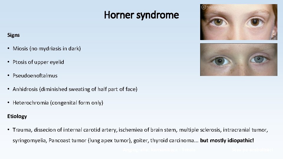 Horner syndrome Signs • Miosis (no mydriasis in dark) • Ptosis of upper eyelid