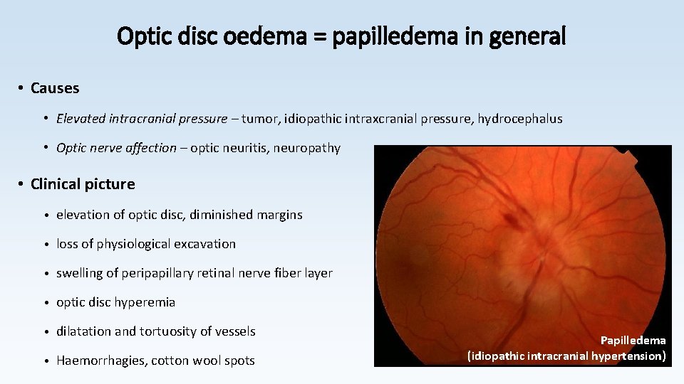 Optic disc oedema = papilledema in general • Causes • Elevated intracranial pressure –