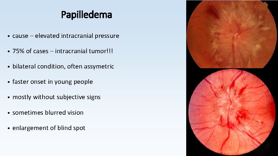 Papilledema • cause – elevated intracranial pressure • 75% of cases – intracranial tumor!!!