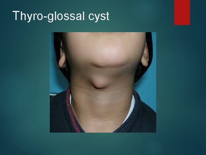 Thyro-glossal cyst 