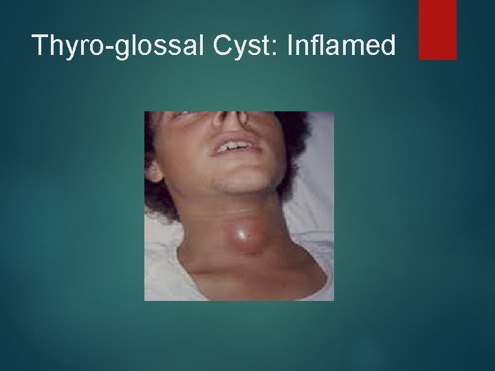 Thyro-glossal Cyst: Inflamed 