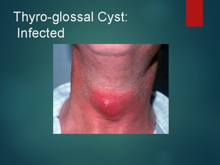 Thyro-glossal Cyst: Infected 