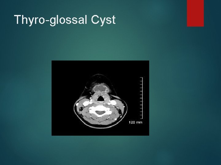 Thyro-glossal Cyst 