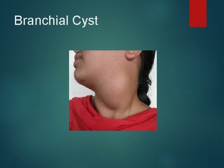 Branchial Cyst 