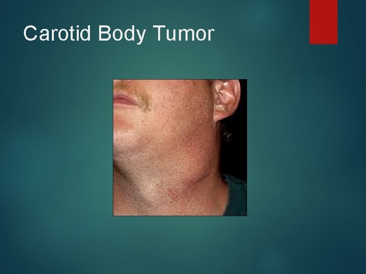 Carotid Body Tumor 