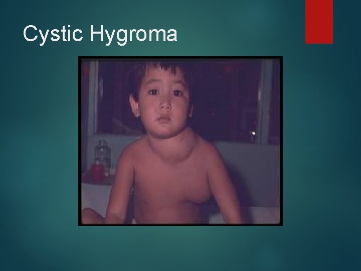 Cystic Hygroma 