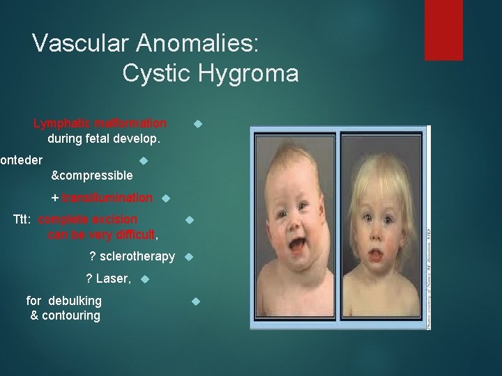 Vascular Anomalies: Cystic Hygroma Lymphatic malformation during fetal develop. nonteder &compressible + transillumination Ttt: