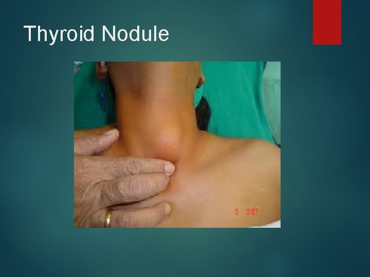 Thyroid Nodule 