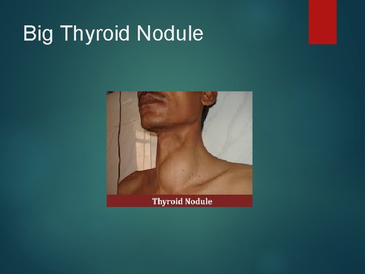 Big Thyroid Nodule 