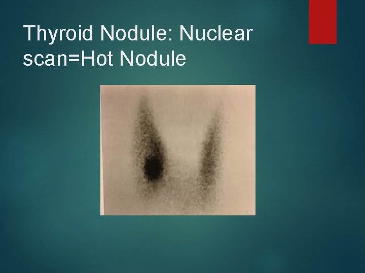 Thyroid Nodule: Nuclear scan=Hot Nodule 