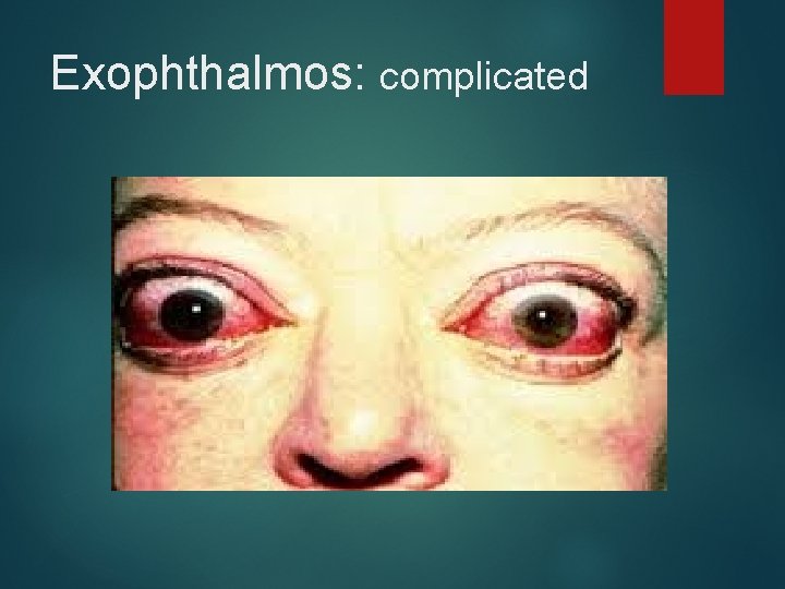 Exophthalmos: complicated 