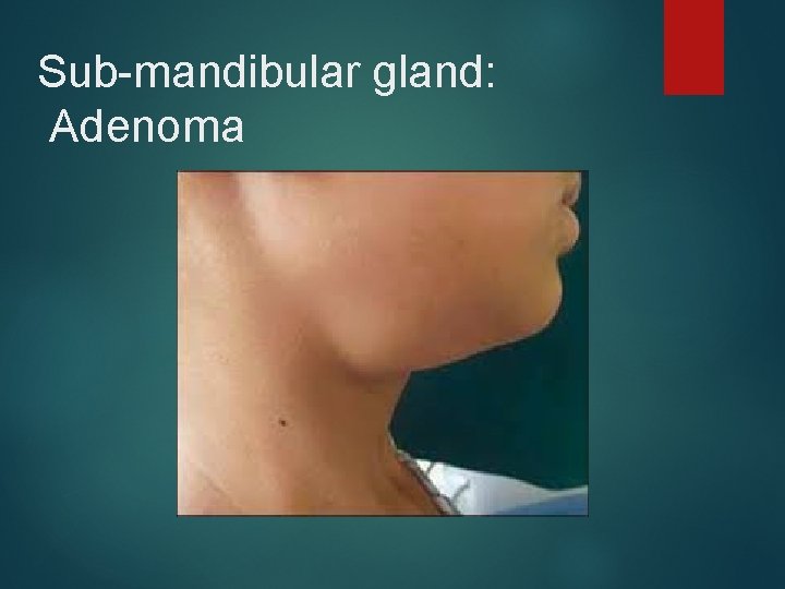 Sub-mandibular gland: Adenoma 