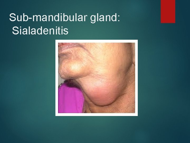 Sub-mandibular gland: Sialadenitis 