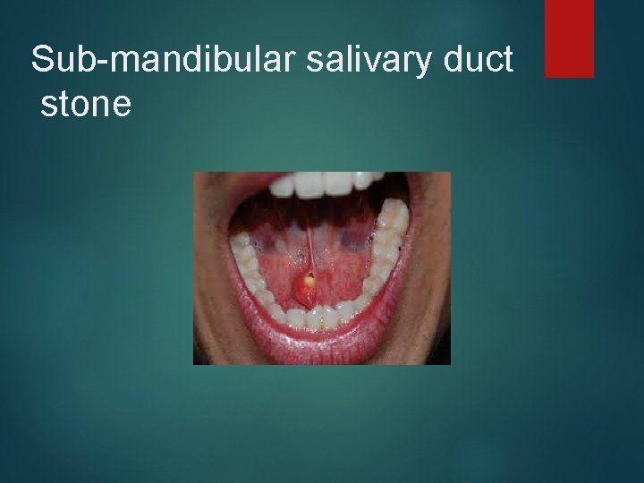 Sub-mandibular salivary duct stone 