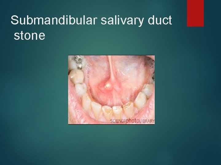 Submandibular salivary duct stone 