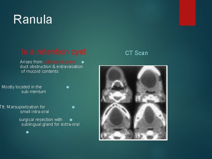 Ranula Is a retention cyst Arises from sublingual gland duct obstruction & extravasation of