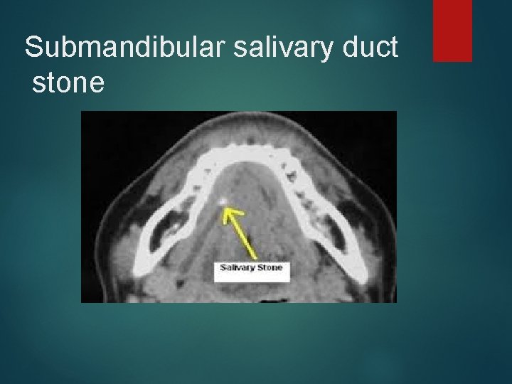 Submandibular salivary duct stone 
