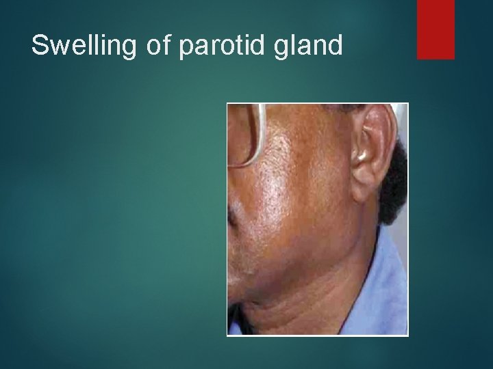 Swelling of parotid gland 