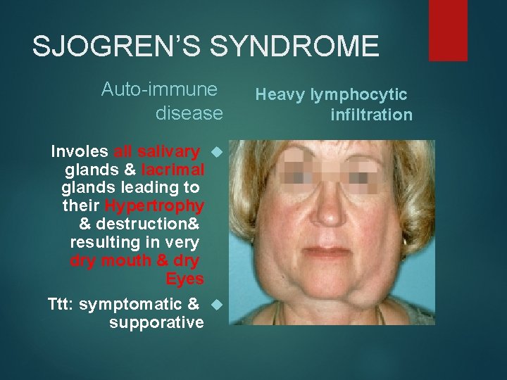 SJOGREN’S SYNDROME Auto-immune disease Involes all salivary glands & lacrimal glands leading to their