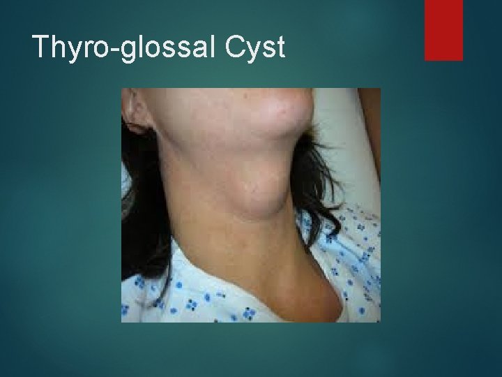 Thyro-glossal Cyst 