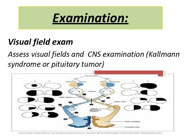 Examination: Visual field exam Assess visual fields and CNS examination (Kallmann syndrome or pituitary