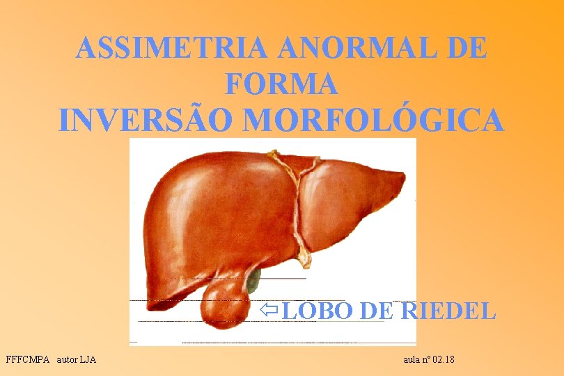 ASSIMETRIA ANORMAL DE FORMA INVERSÃO MORFOLÓGICA ïLOBO DE RIEDEL FFFCMPA autor LJA aula nº ASSIMETRIA ANORMAL DE FORMA INVERSÃO MORFOLÓGICA ïLOBO DE RIEDEL FFFCMPA autor LJA aula nº