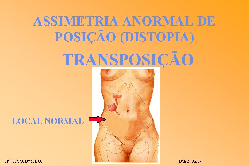 ASSIMETRIA ANORMAL DE POSIÇÃO (DISTOPIA) TRANSPOSIÇÃO LOCAL NORMAL FFFCMPA autor LJA aula nº 02. ASSIMETRIA ANORMAL DE POSIÇÃO (DISTOPIA) TRANSPOSIÇÃO LOCAL NORMAL FFFCMPA autor LJA aula nº 02.