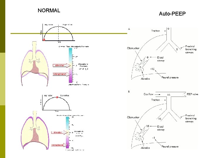 NORMAL Auto-PEEP 