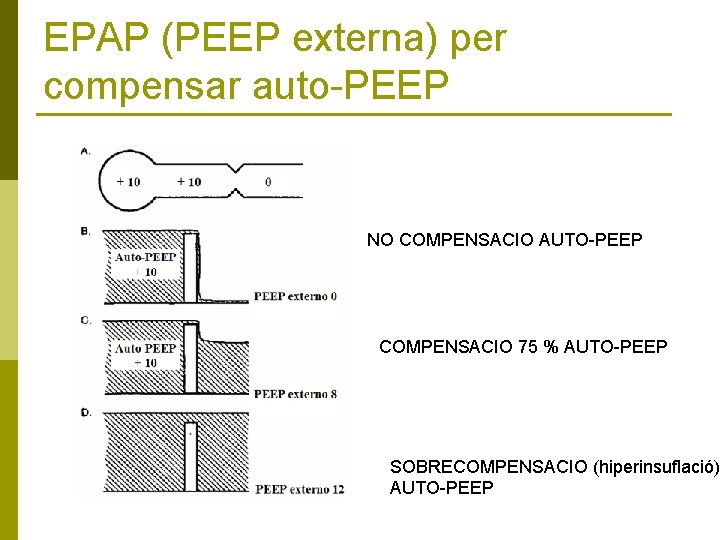 EPAP (PEEP externa) per compensar auto-PEEP NO COMPENSACIO AUTO-PEEP COMPENSACIO 75 % AUTO-PEEP SOBRECOMPENSACIO