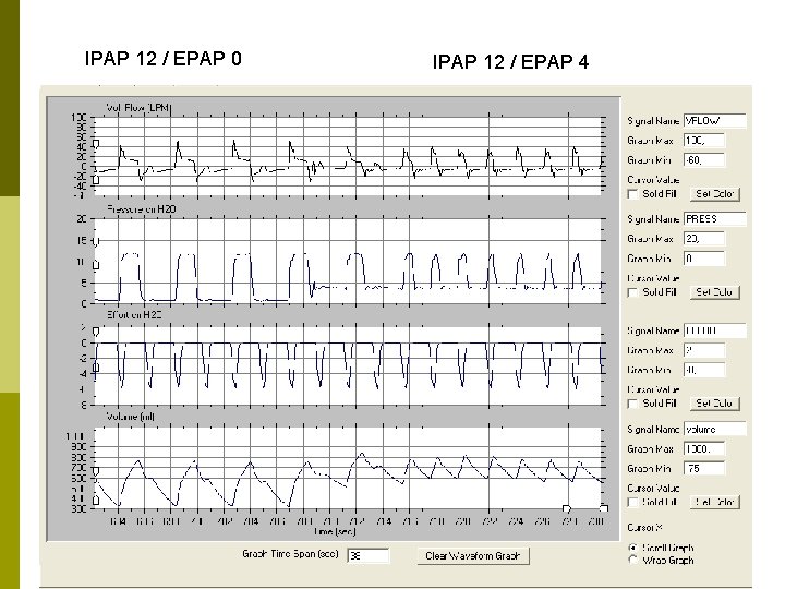 IPAP 12 / EPAP 0 IPAP 12 / EPAP 4 