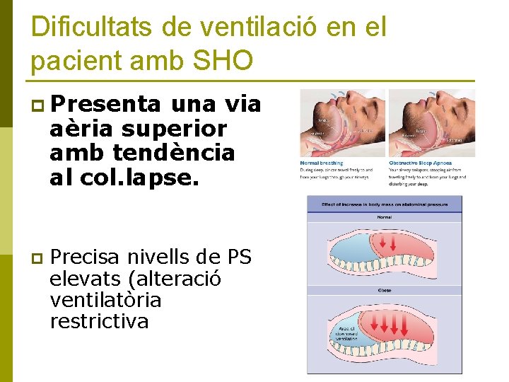 Dificultats de ventilació en el pacient amb SHO p Presenta una via aèria superior