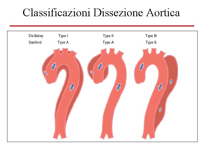Classificazioni Dissezione Aortica 