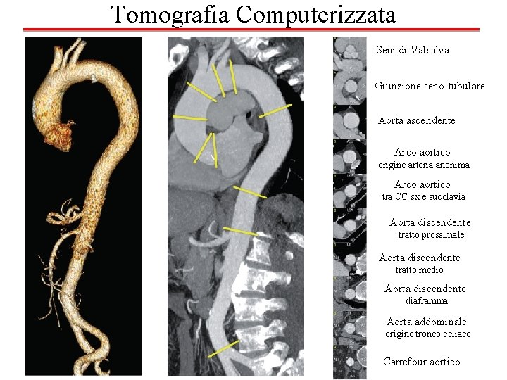 Tomografia Computerizzata Seni di Valsalva Giunzione seno-tubulare Aorta ascendente Arco aortico origine arteria anonima