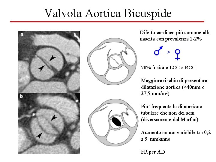 Valvola Aortica Bicuspide Difetto cardiaco più comune alla nascita con prevalenza 1 -2% >